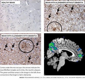 050-053_Alzheimer_215-B-ING