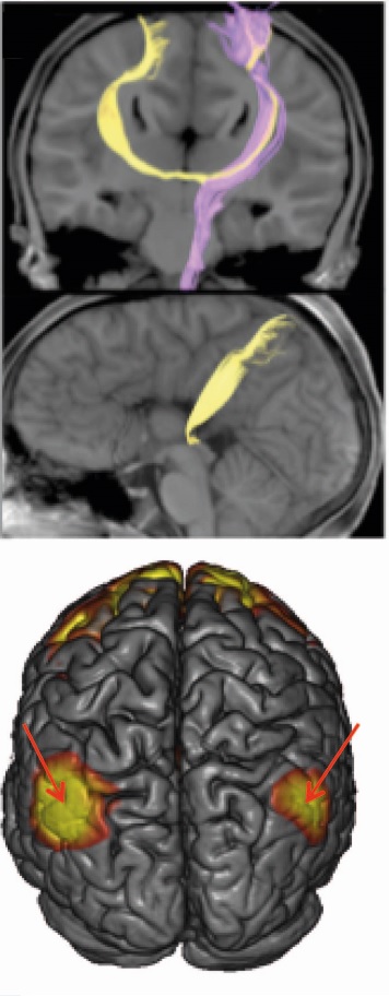 Vias cerebrais alternativas na Disgenesia do Corpo Caloso. (A) Feixe inter-hemisférico aberrante (amarelo) e córtico-espinhal normal (roxo) reconstruídos por fascigrafia e sobreposto em uma imagem anatômica em uma visão coronal (superior) e sagital em um paciente com Disgenesia do Corpo Caloso. (B) Conectividade inter-hemisferica funcional (setas) preservada em pacientes que nascem sem o corpo caloso. As setas indicam regiões cerebrais conectadas funcionalmente mesmo na ausência do corpo caloso.