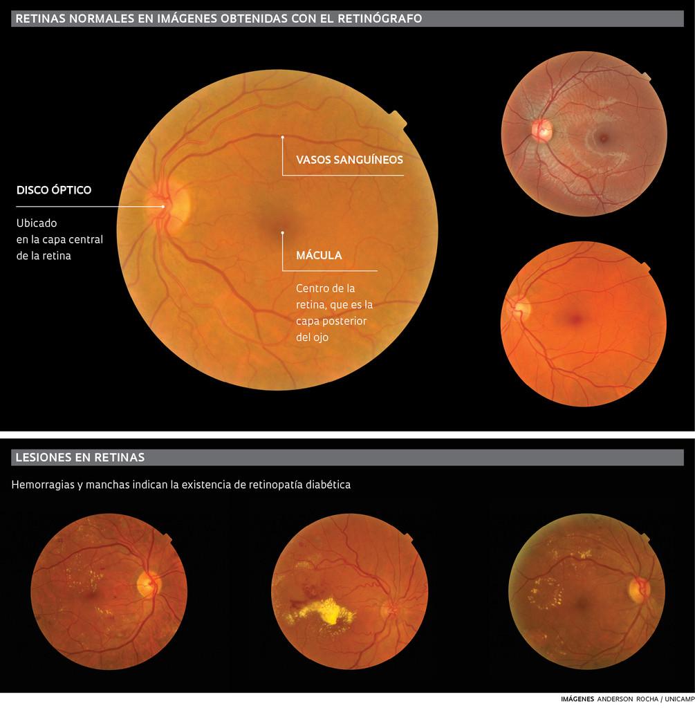 olhos_Cegueira_214