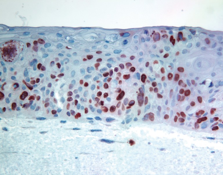 Microscopia de infecção por papiloma vírus (HPV)...
