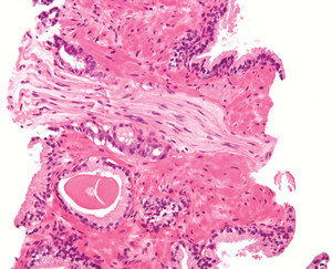 Un adenocarcinoma bajo el microscopio: el tipo más común de cáncer de próstata