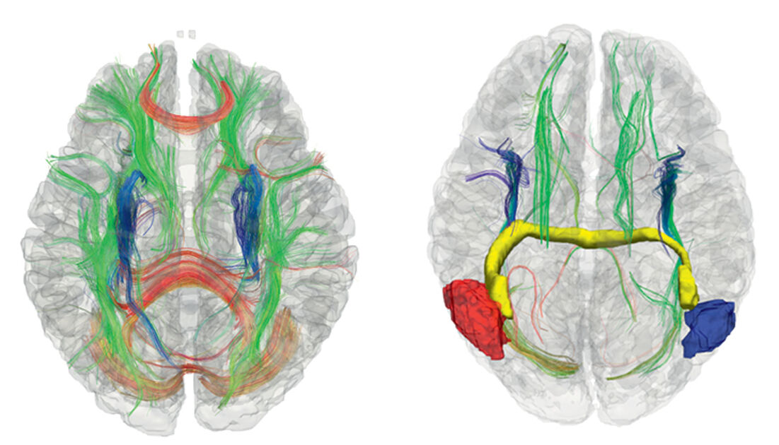 hemisférios cerebrais e corpo caloso