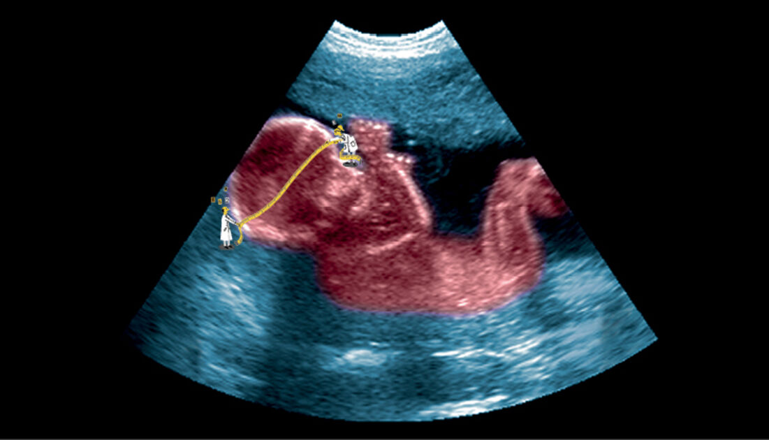 Como Calcular Comprimento Do Bebe Pelo Femur