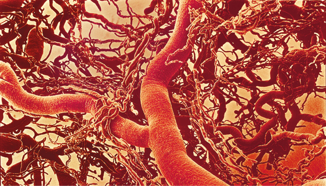 Болезни кровеносного сосуда. Микроциркуляторное русло кровообращения. Микроциркуляторное русло под микроскопом. Васкулит микрососудистого русла. Микроциркуляторное русло клетки.