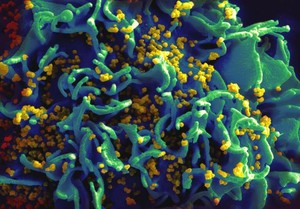 Micrografia eletrônica de varredura de partículas de HIV infectando uma célula T H9 humana, colorida em azul, turquesa e amarelo